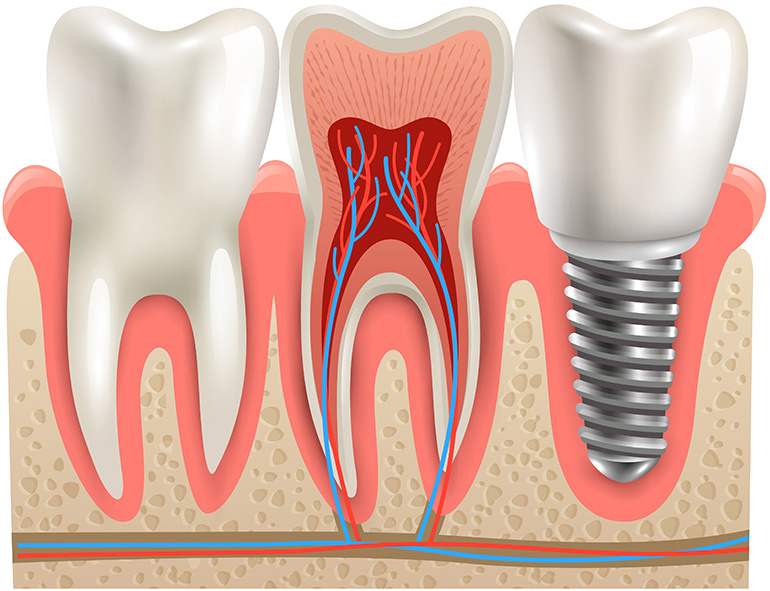 Implantatbehandling